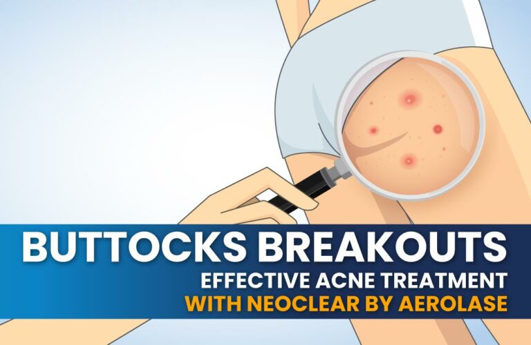 NeoClear by Aerolase Buttocks Acne Breakouts Treatment