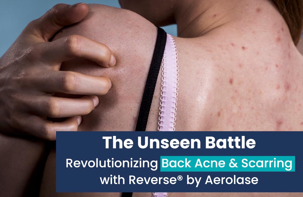 Treat Back Acne and Scarring with Reverse by Aerolase