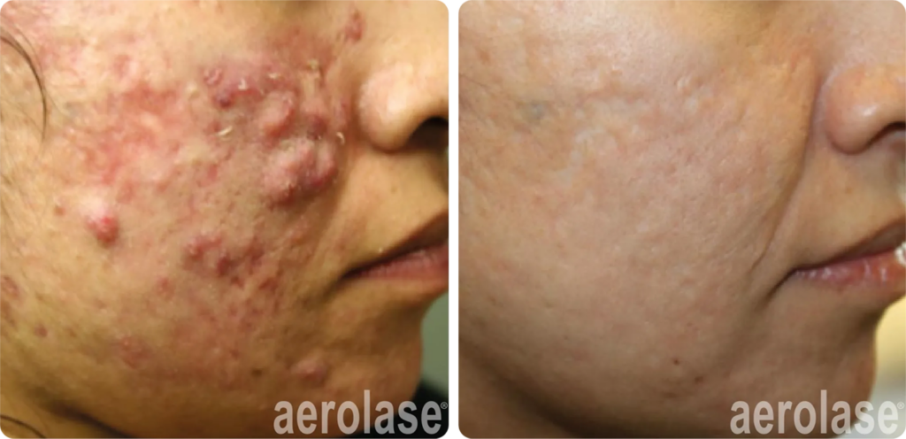 Breakthrough-Acne-Solution-Before-and-After-2-2048x991