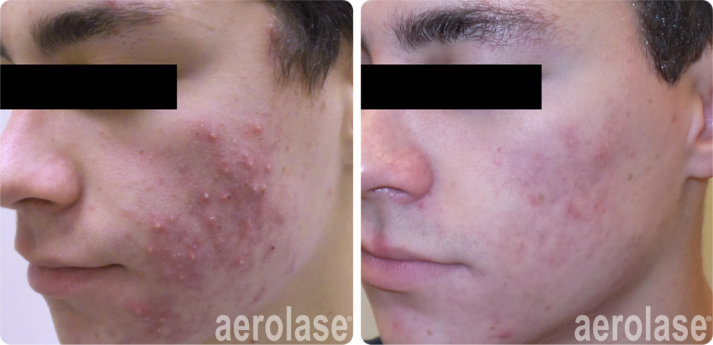 acne-cheeks-pinski-before-and-after