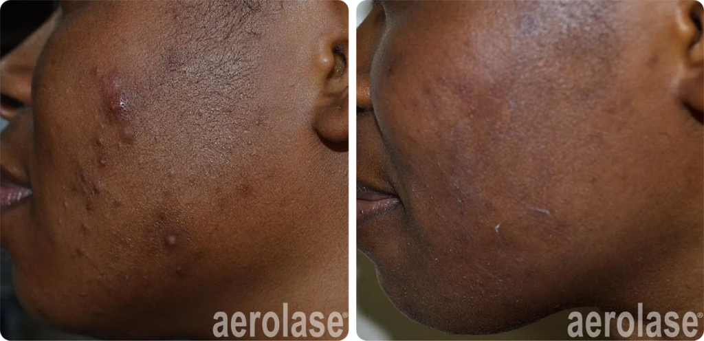 reupload-acne-cheeks-awudu-skinofcolor-before-and-after