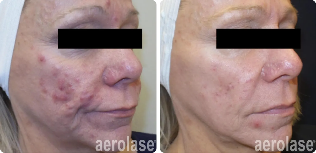 reupload-acne-cystic-pinski-before-and-after