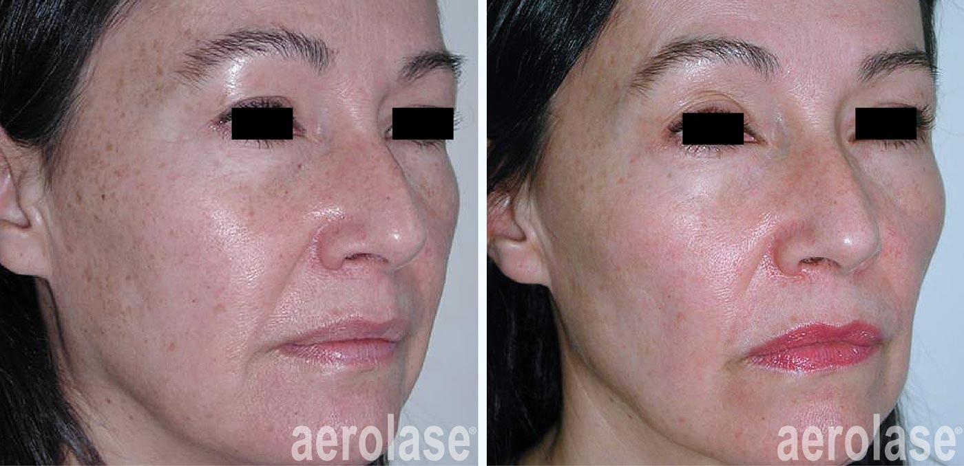 Aerolase Sun Damage and Fine Lines James Newman