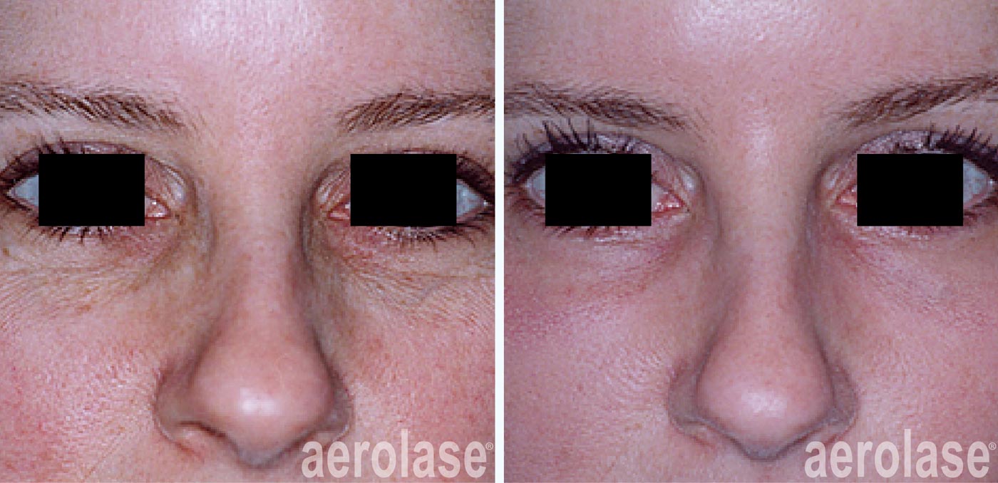 Aerolase Wrinkles and Crows Feet James Gordon