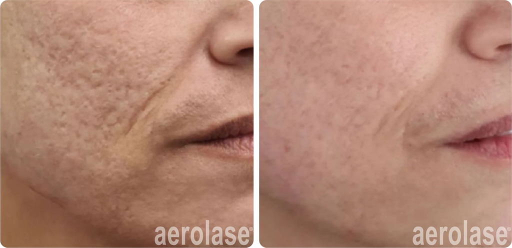 acne-scars-watfa-before-and-after-smaller-for-web