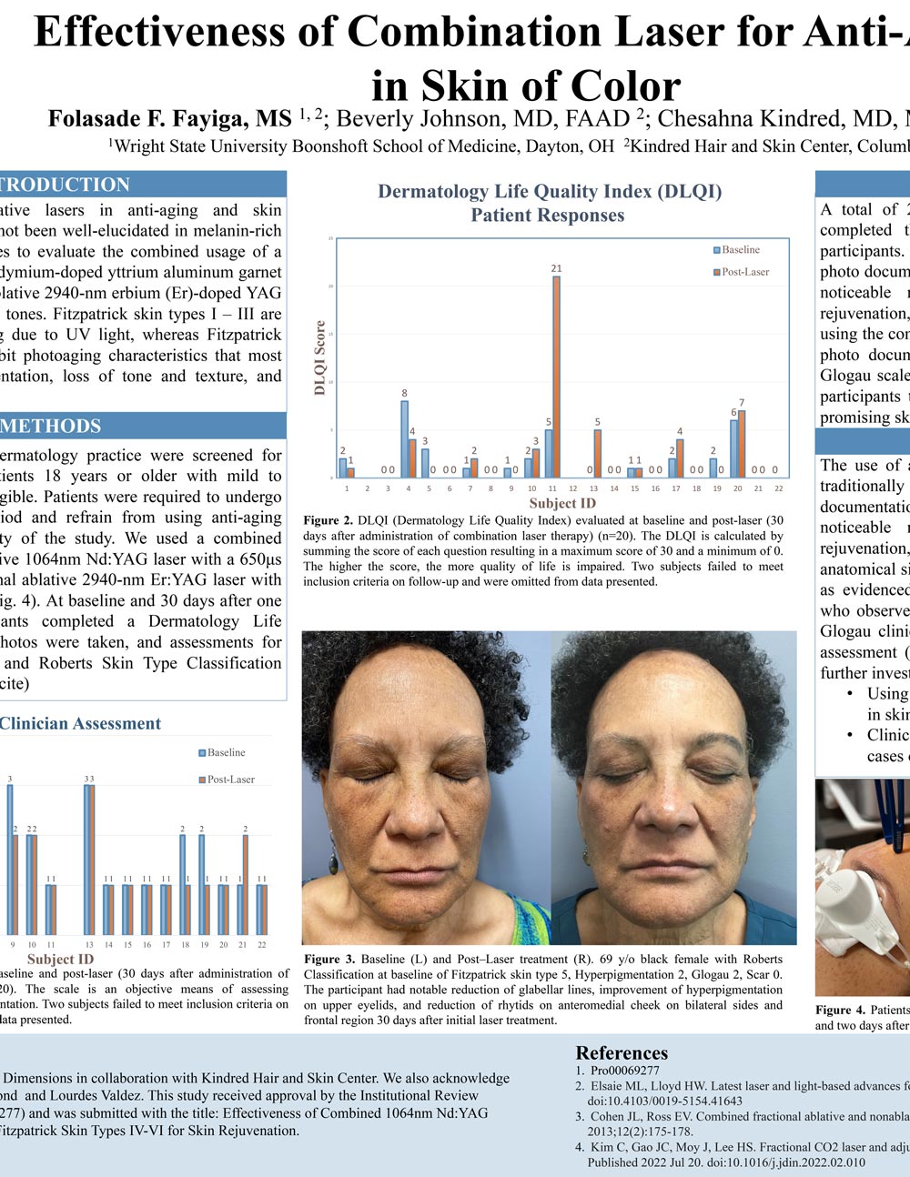 Aerolase Chesahna Kindred Effectiveness of Combination Laser for Anti-Aging in Skin of Color Clinical Study