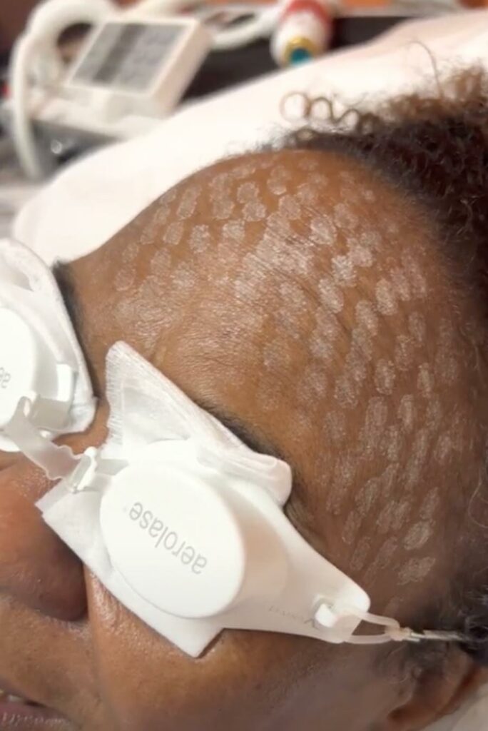 Aerolase Clinical Study Skin of Color Patient Receiving EraElite Treatment