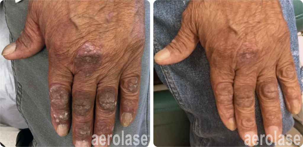 psoriasis-before-and-after-1