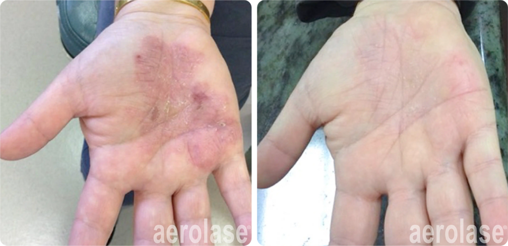 psoriasis-before-and-after-2