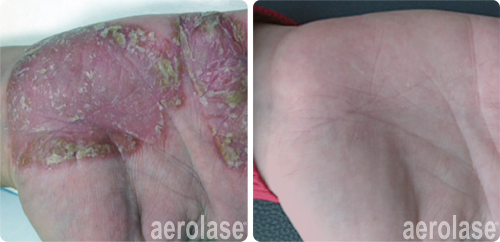 psoriasis-before-and-after-3