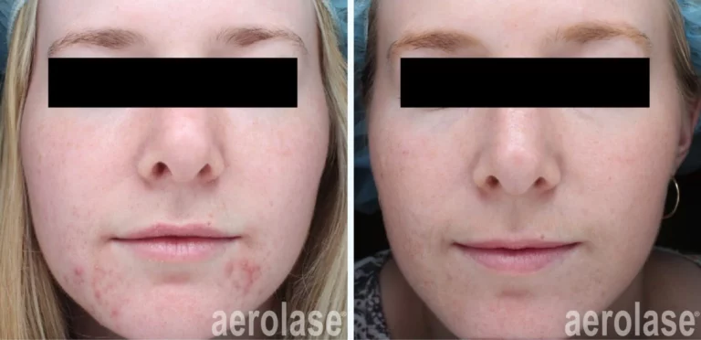 Comedonal Acne