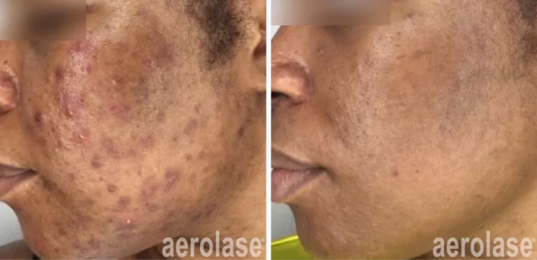 Post-Acne Hyperpigmentation