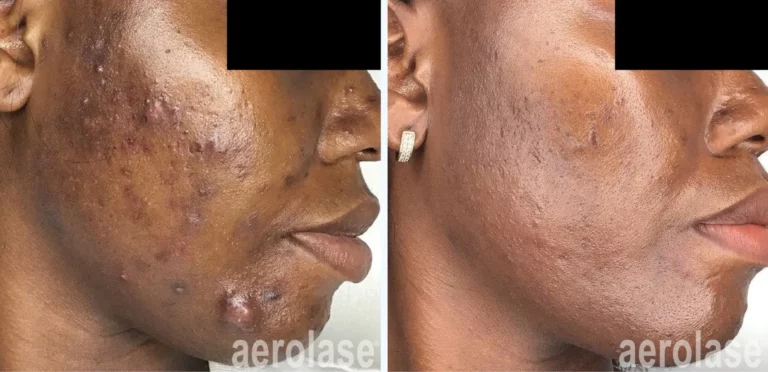 Nodular or Cystic Acne