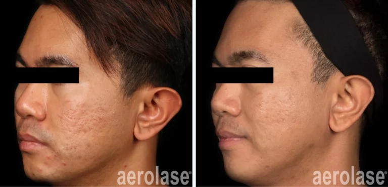 Acne and Acne Scars