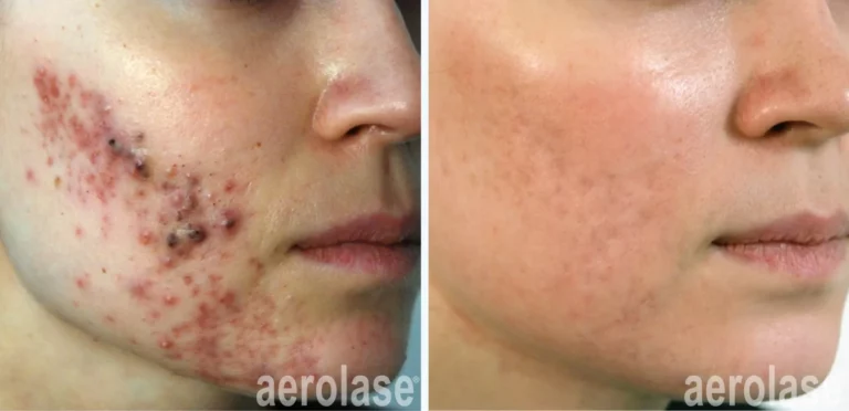 Cystic Acne with Isotretinion