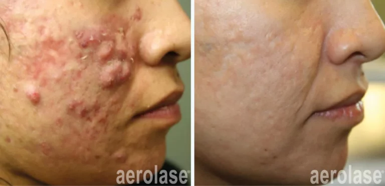 Nodular or Cystic Acne