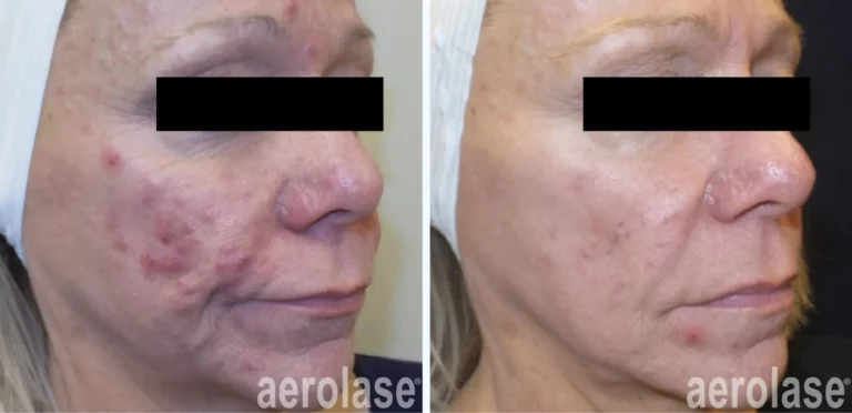 Cystic Acne