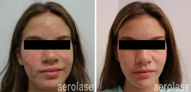 Comedonal Acne