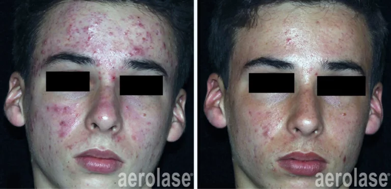 Comedonal Acne