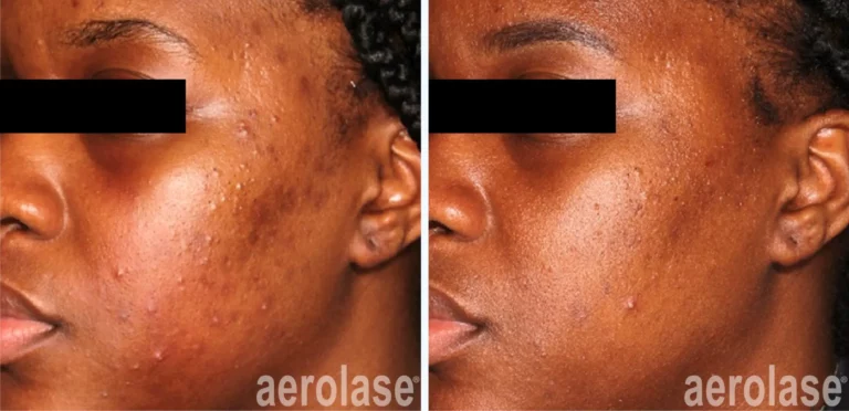 Papular or Pustular Acne