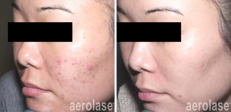 Papular or Pustular Acne