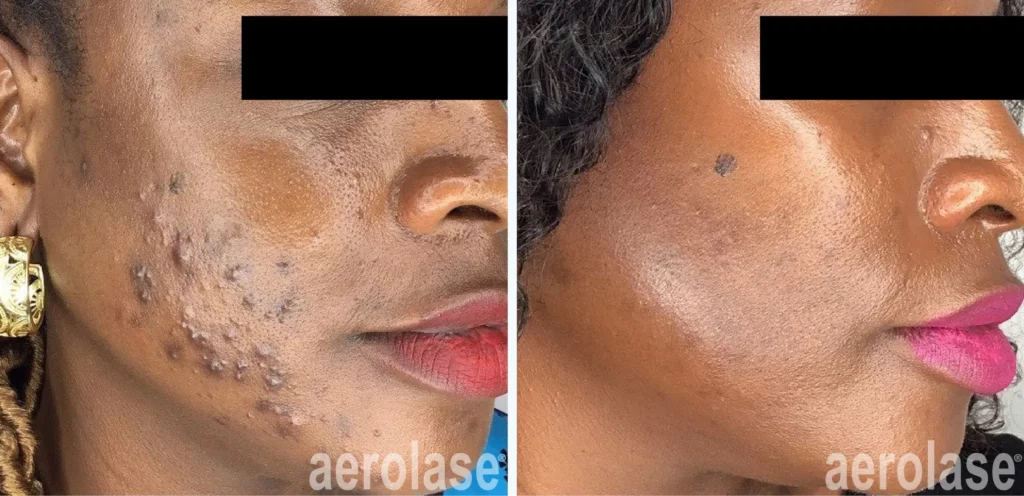 Nodular or Cystic Acne. Photos Courtesy of Sholema Clinics