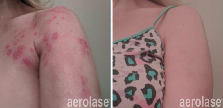 Psoriasis