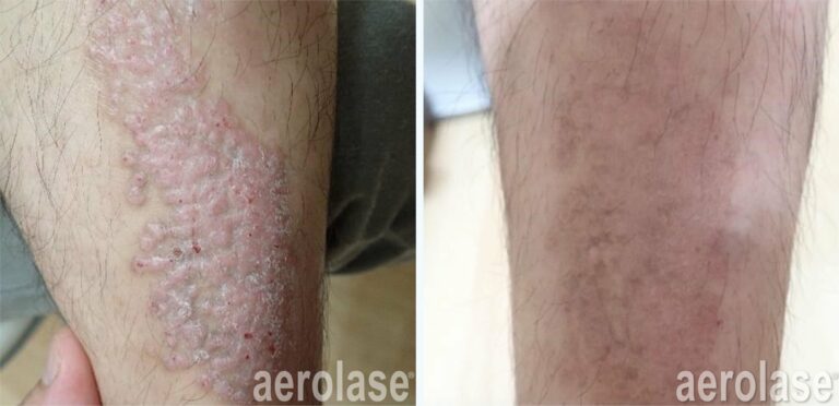 Atopic Dermatitis