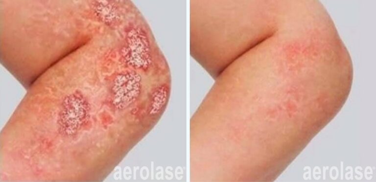 Psoriasis