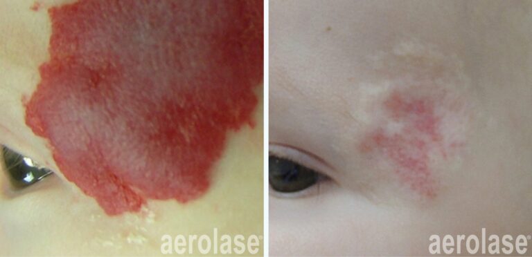 Infantile Hemangioma