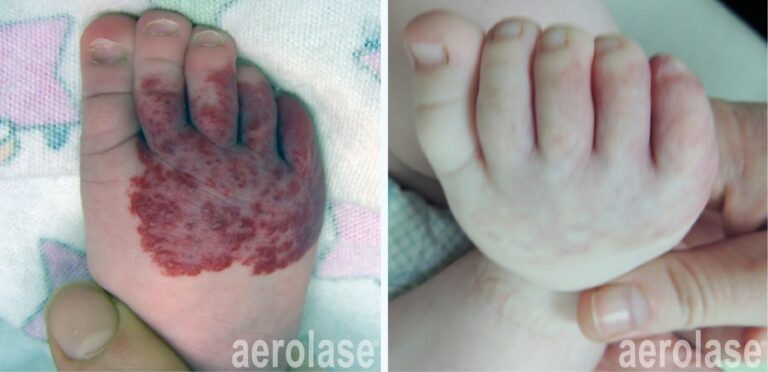 Infantile Hemangioma