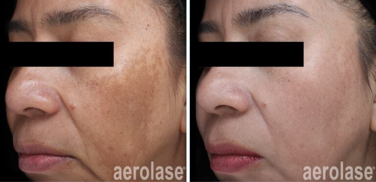 Melasma