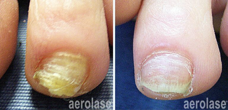 Nail Fungus