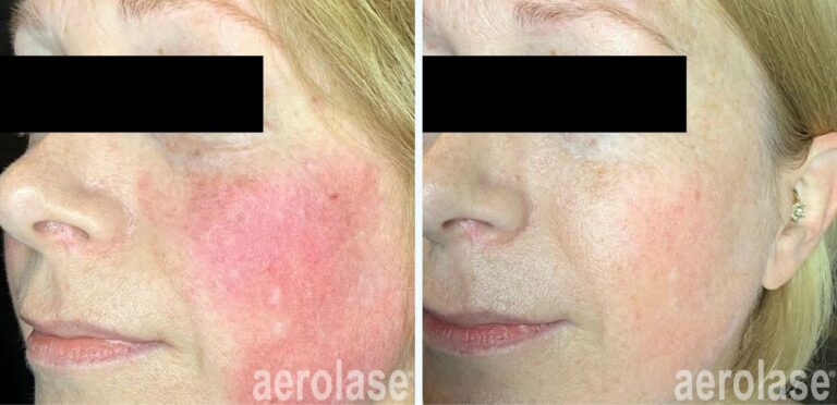 Rosacea