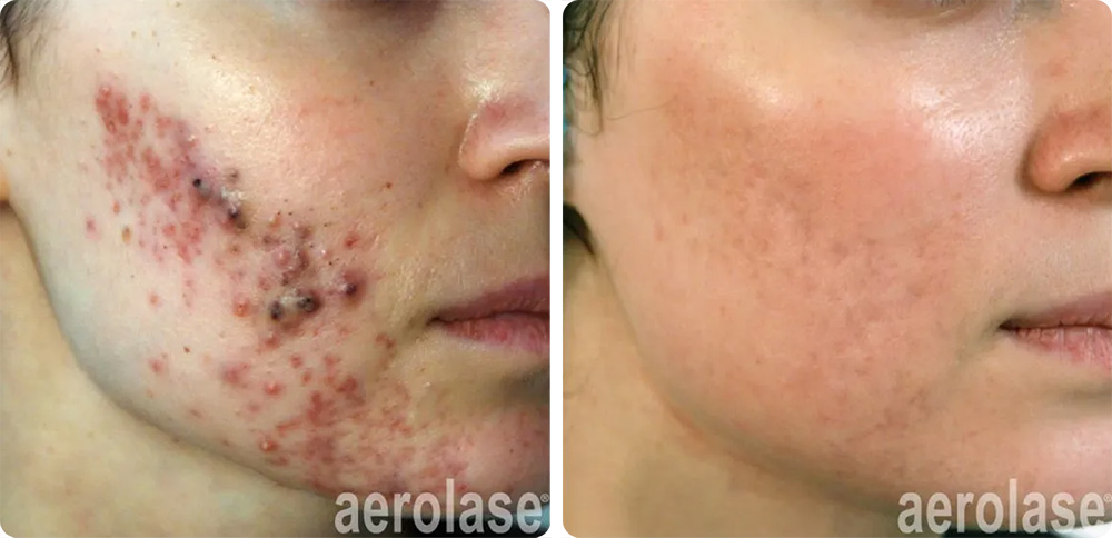 Cystic Acne with Isotretinion