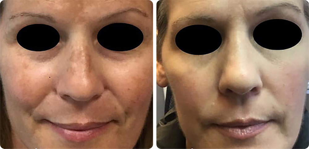 Melasma