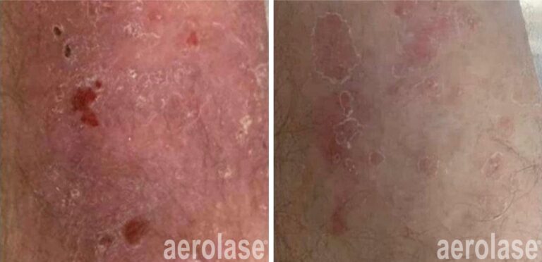 Psoriasis