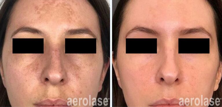 Melasma